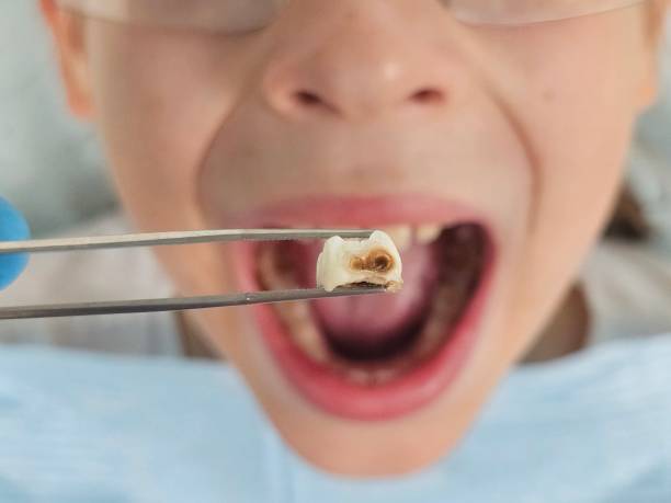 Best Chipped Tooth Repair Near Me  in North Port, FL
